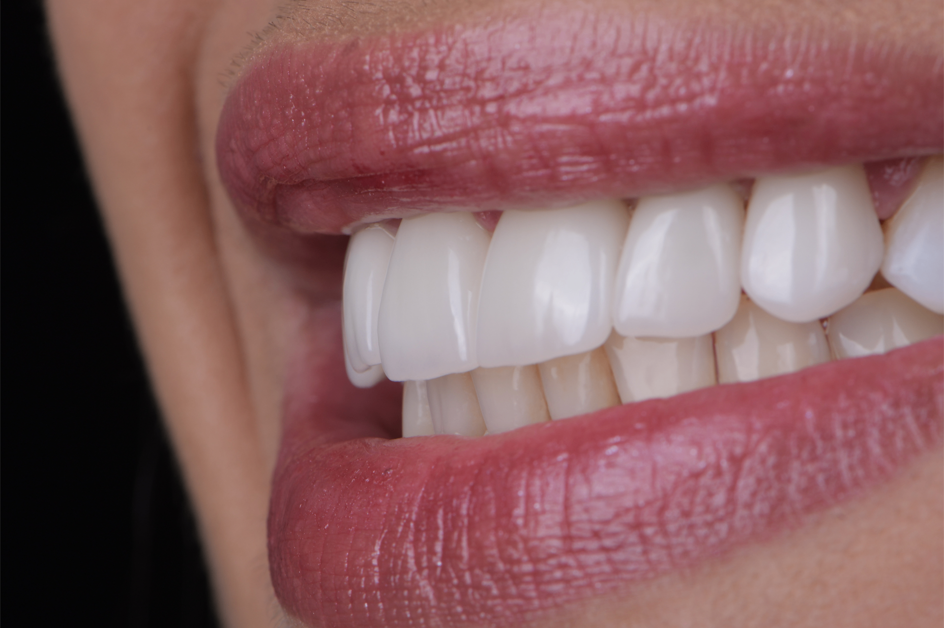 Sorriso de alto padrão Dental Studio Campo Mourão